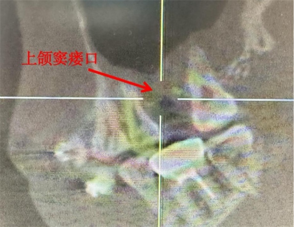 图片3.jpg 拔牙后吃饭喝水总“漏风”?原来有个“小隧道”(图3)