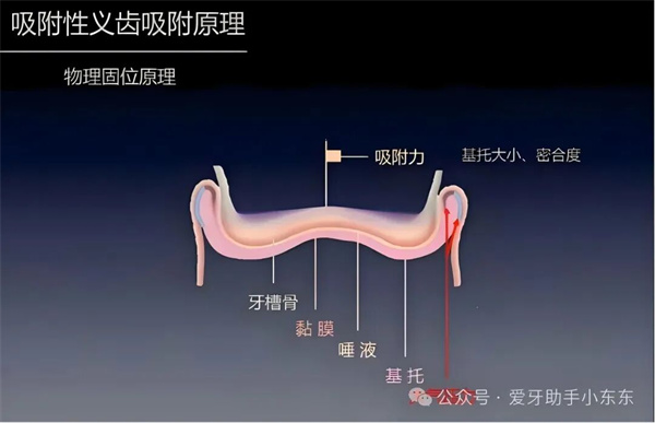 缺牙人的“救星”,解锁“吸附性义齿”(图2) 缺牙人的“救星”,解锁“吸附性义齿”(图2)
