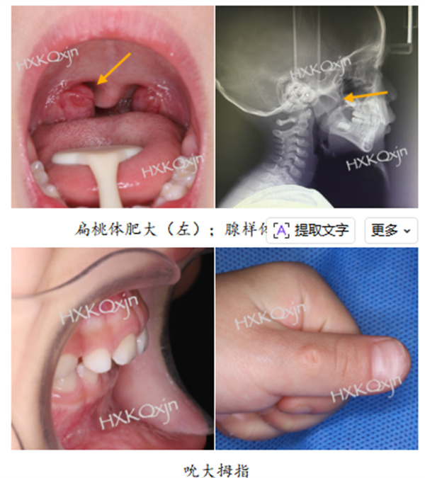 ScreenShot_2026-04-27_192851_010.jpg 孩子乳牙“天包地”,到底要不要矫正?(图5)
