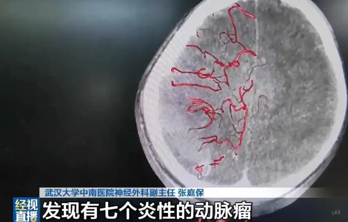 10岁男孩徒手拔烂牙，几个月后突发大量脑出血！医生：口腔感染入血，一路侵袭心脏瓣膜，攻入大脑……紧急提醒(图1)